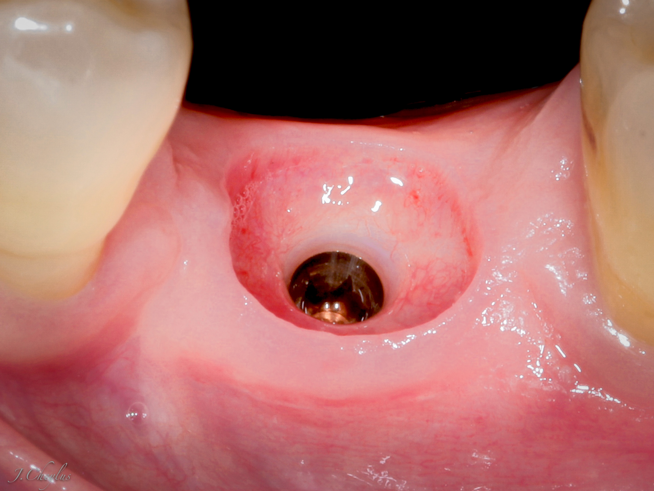 cicatrice gingivale