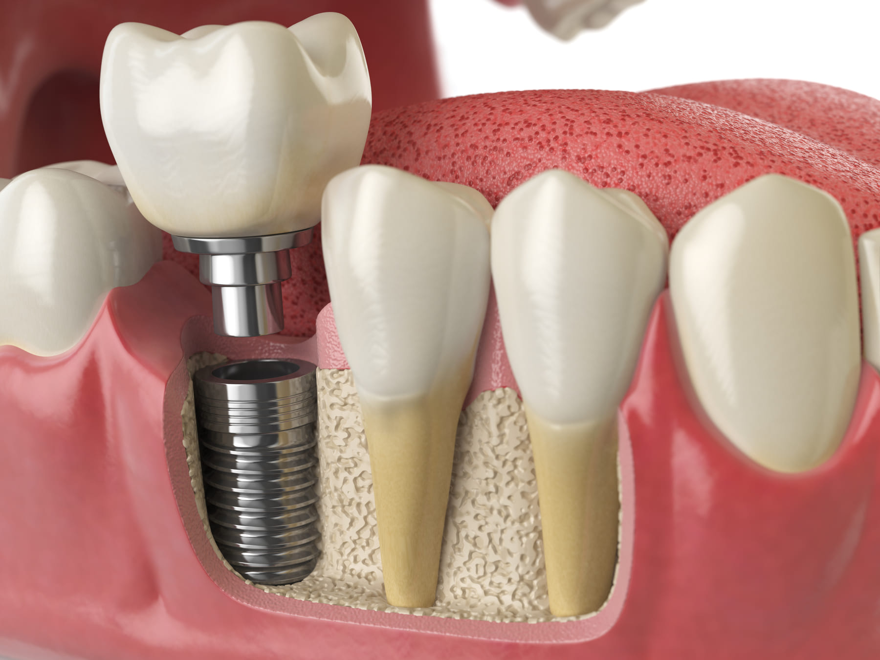 implant dentaire déconnexion pilier