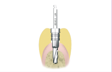 Foret préparation implant dentaire