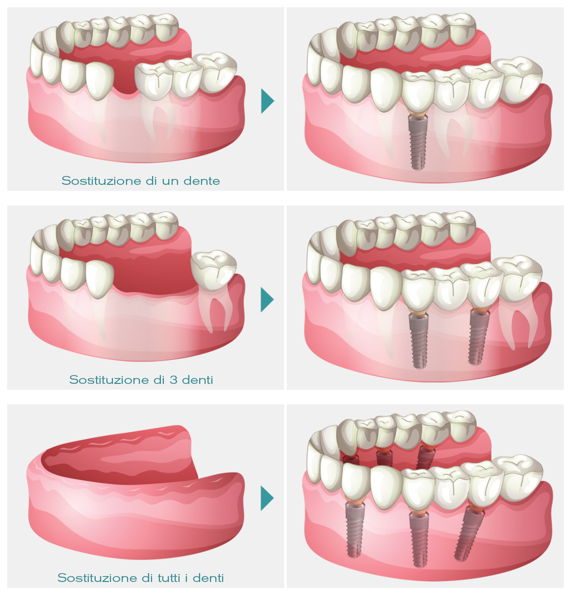 casi di impianti dentali