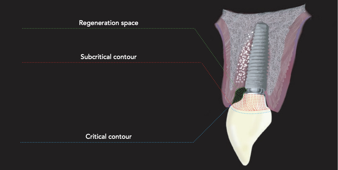 Contours gingivaux restaurations implants