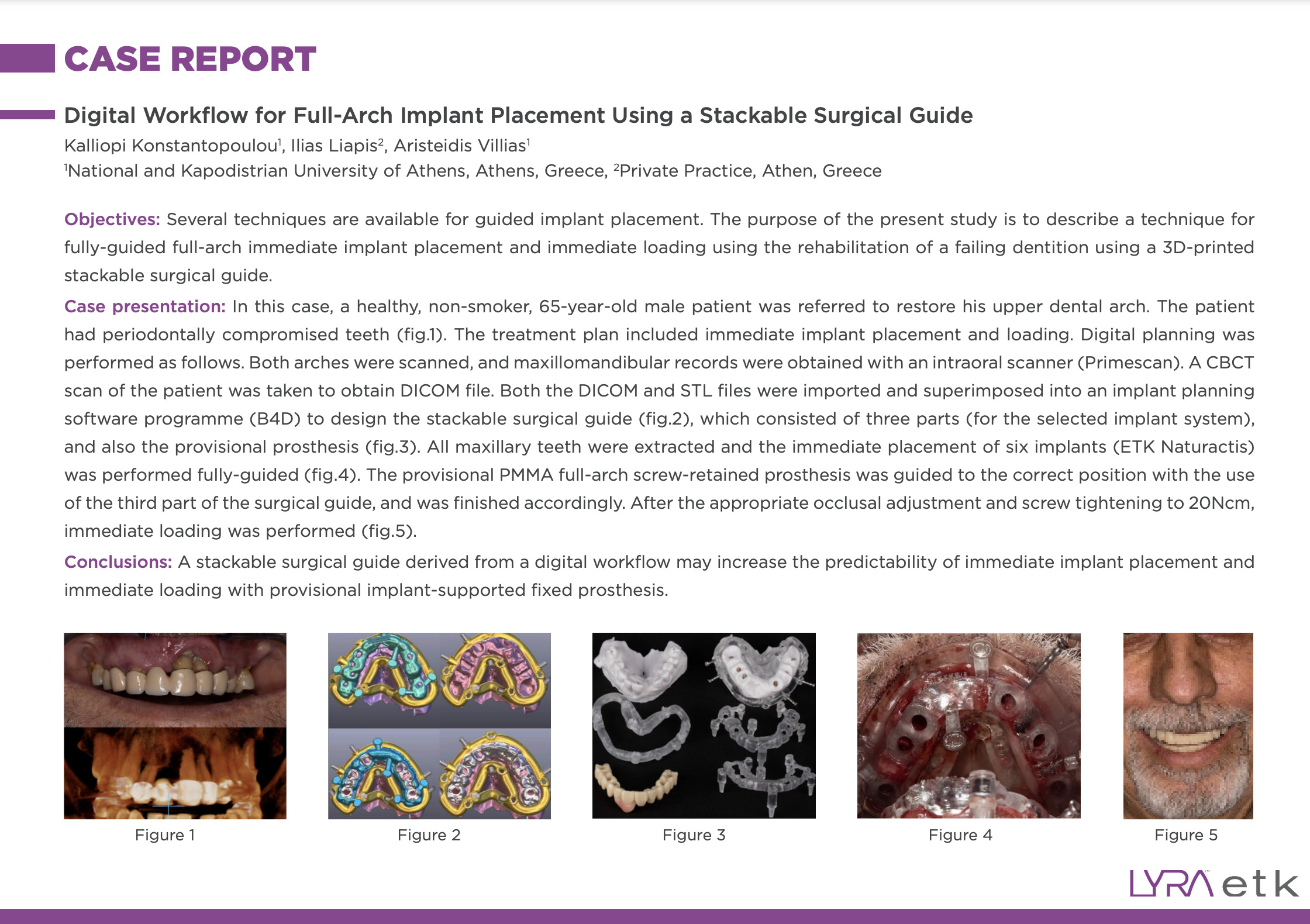 Digital workflow implant placement
