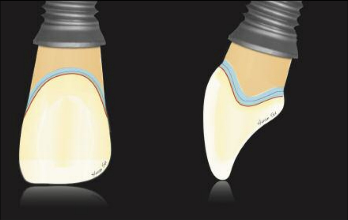 Implantologie dentaire contour critique couronnes