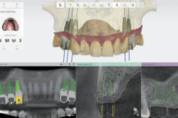 écran implantologie dentaire