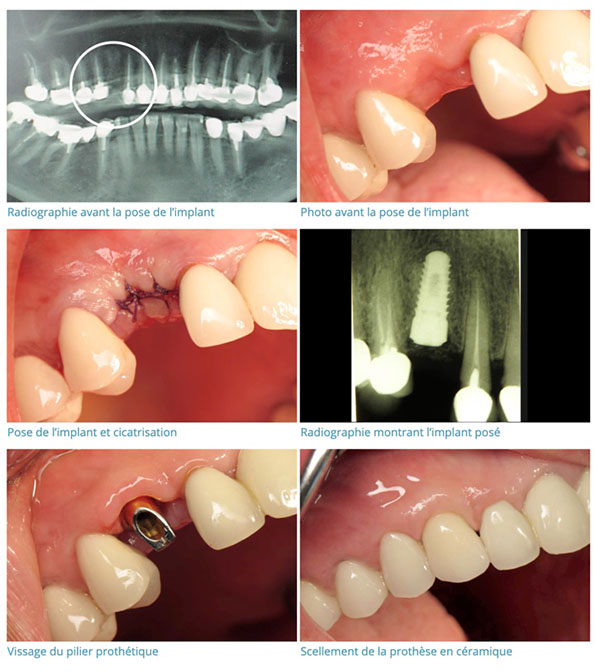 étapes pose d'implant dentaire