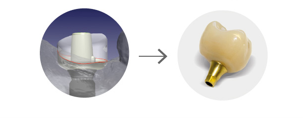 guide prothèse ibone iphysio