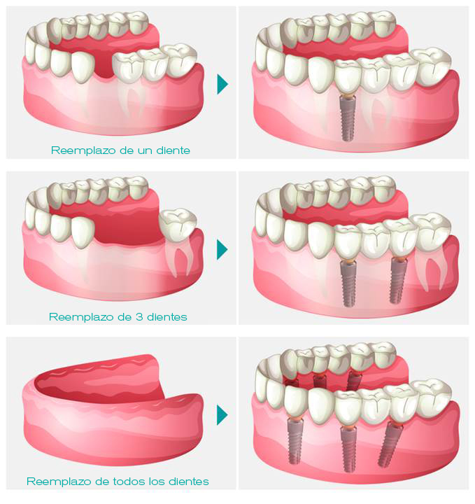 implant dentaire process