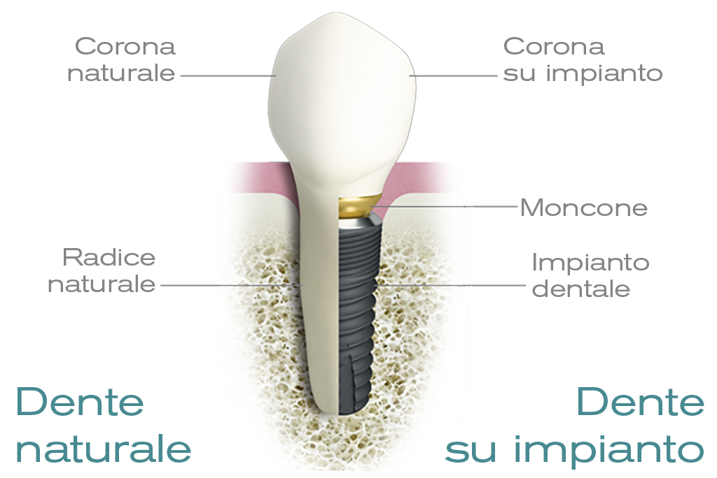 dente su impianto