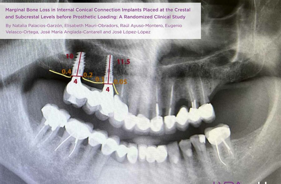 marginal bone loss study