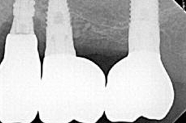 thèse implants courts maxillaire postérieur